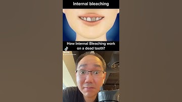 How internal whitening on a dead tooth? 🧐