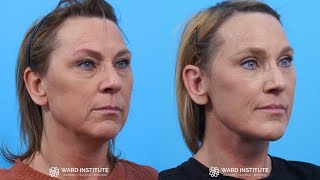 ACTUAL Plastic Surgery Patient Experience | Doc Talk with Dr. Ward