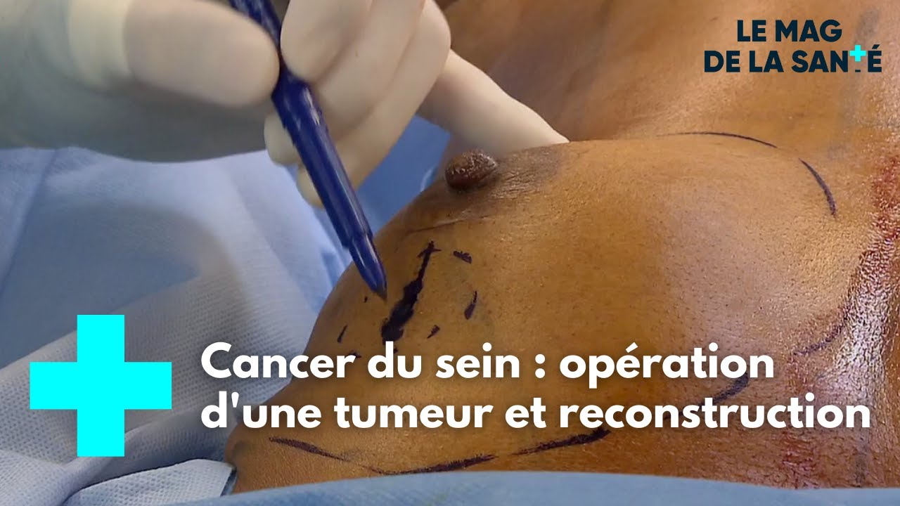 Download Une seule opération pour retirer une tumeur et reconstruire un sein - Le Magazine de la Santé