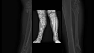 99% Will Miss This Rare Bone Disease X-Ray #shorts
