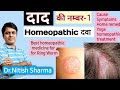 दाद की homeopathic दवा | best homeopathic medicine for RING WORM | #ringworm