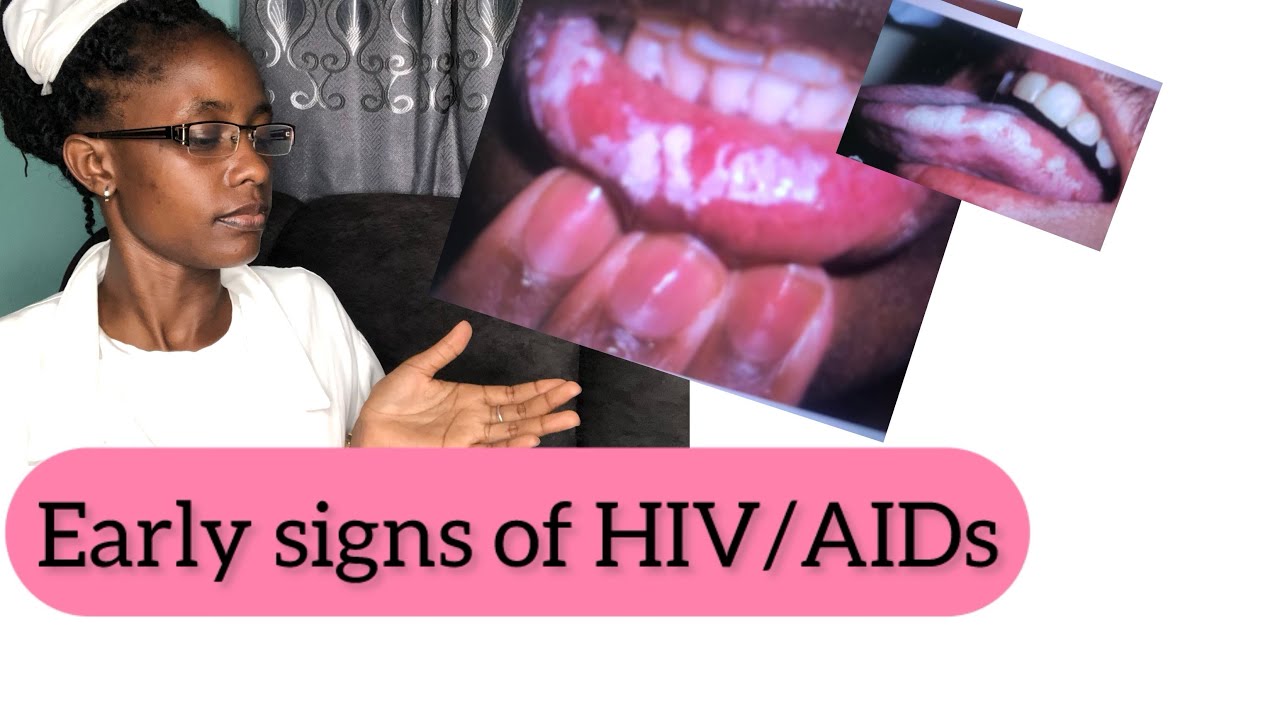 Signs and symptoms of HIV and AIDs ep5 - YouTube