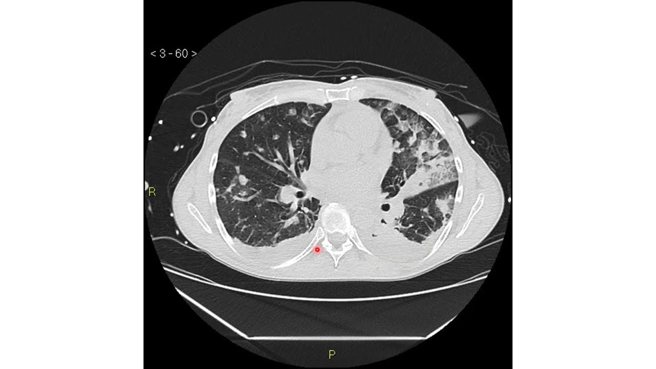 SDRA - Fisiopatología