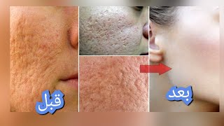 معلقه واحده تخلصك من المسام الواسعه-وتزيل حبوب الوجه وحروق الشمس وتجعل بشرتك نضيفه ناعمه??