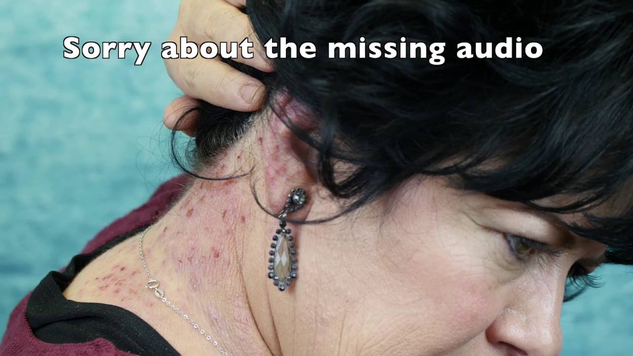 What An Eczema Flare Up Looks Like 