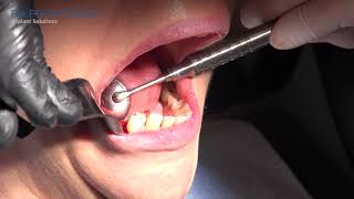 Reconstruction of posterior mandible - Prof. Ziv Mazor