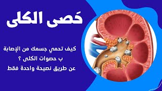 حصى الكلى | التشخيص والعلاج kidney_stone