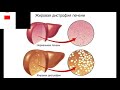 ГЛАВНЫМ ПРИЗНАКОМ ОСТРОЙ ЖИРОВОЙ ДИСТРОФИИ ПЕЧЕНИ ЯВЛЯЕТСЯ