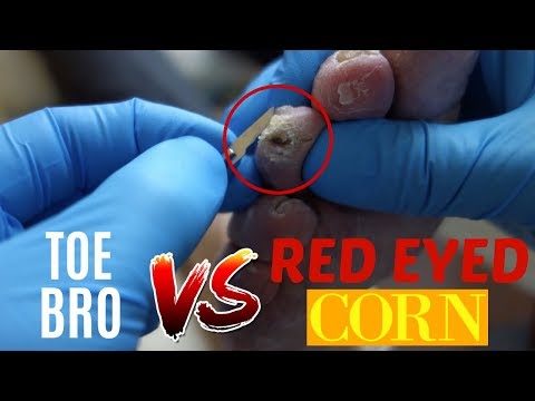 PAINFUL CORN REMOVAL AND THICK TOENAIL CLIPPING ON CLAWED TOES
