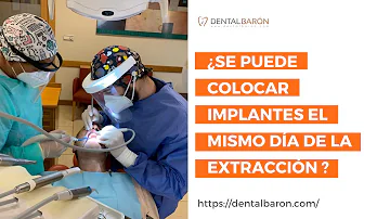 ¿Es necesario un implante tras una extracción dental?