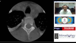 Radiology Teaching On Cervical Spine Ct By Dr Arjunkalyanpur