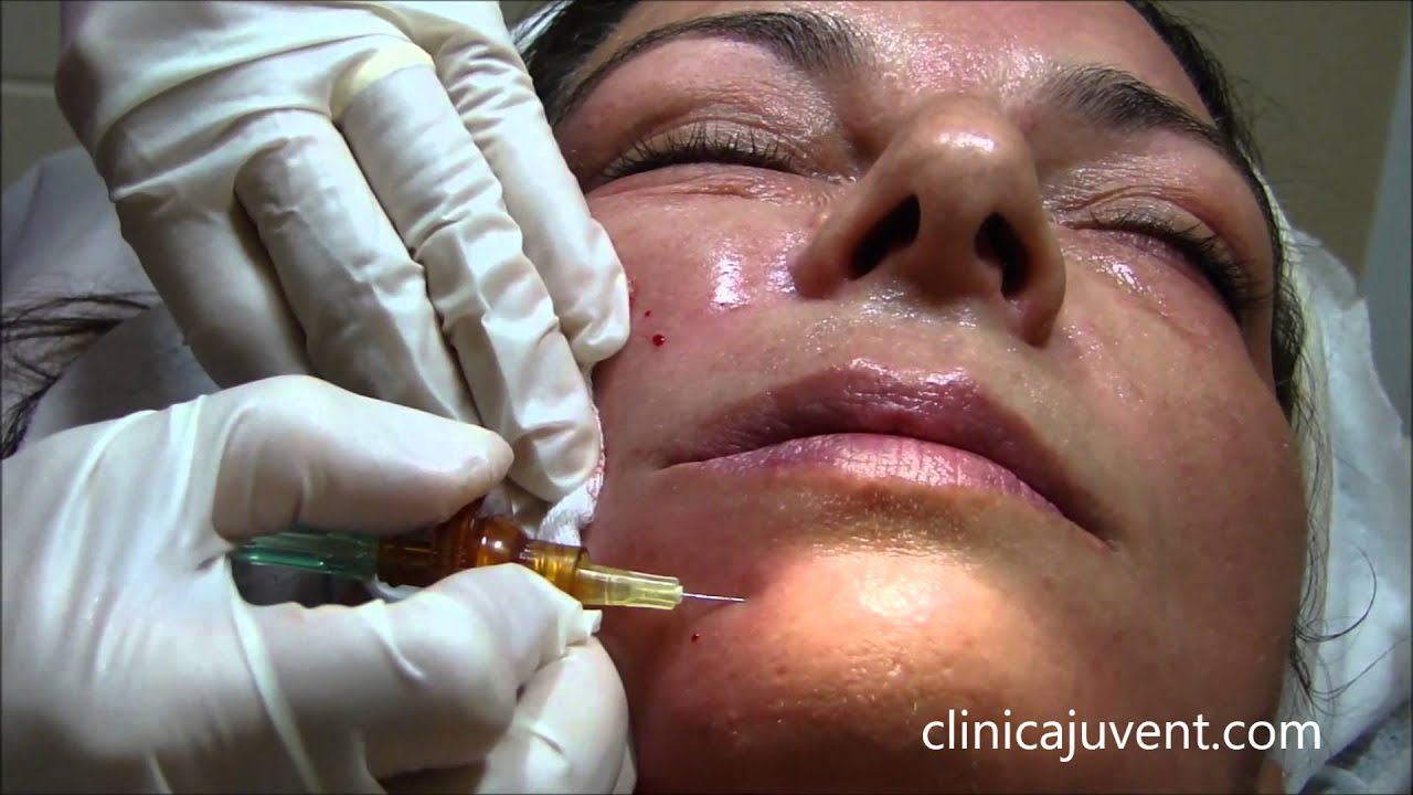 Cuantas inyecciones de carboxiterapia