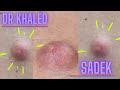 Massive Back Cyst. Dr Khaled Sadek. LipomaCyst.com
