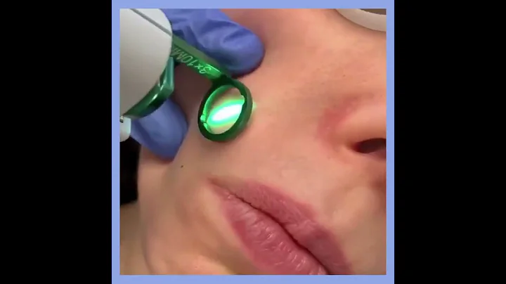 Is VBEAM right for your face? | Gendler Dermatology