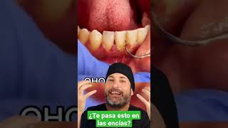 Si te pasa ESTO en tus ENCÍAS es que el SARRO DENTAL está empezando a ser un PROBLEMA