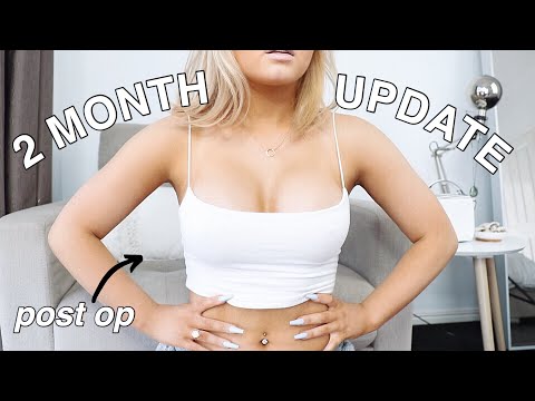 TWO MONTH POST OP UPDATE | BREAST AUGMENTATION Q&A | Conagh Kathleen
