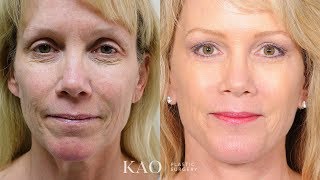 Kao Plastic Surgery  PONYTAIL LIFT™  Plastic Surgery  Facelift with Real Long Lasting Results!