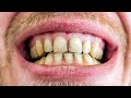      teeth tartar and how to remove it