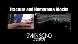 Find that fracture in seconds (with no radiation!) AND perform that hematoma block with precision!