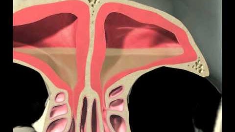 Balloon Sinuplasty animation