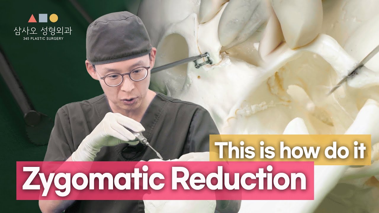 "Cheekbone Reduction Surgery: See How It's Actually Done! A Big Difference? [345 Plastic Surgery]"