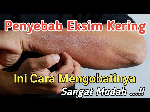 Cara Mengobati Eksim Kering , Dermatitis 
