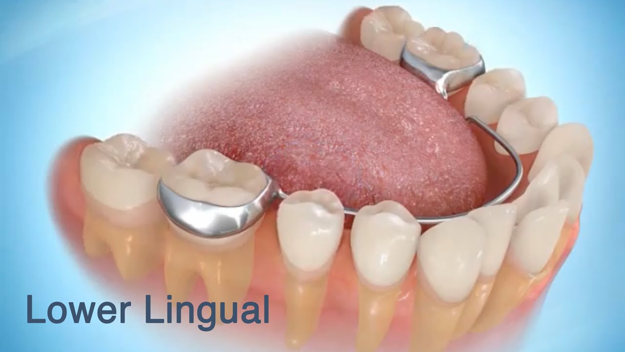 Lower Lingual Arch YouTube