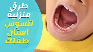 طرق منزلية لعلاج تسوس الاسنان عند الاطفال وطرق الوقاية منه