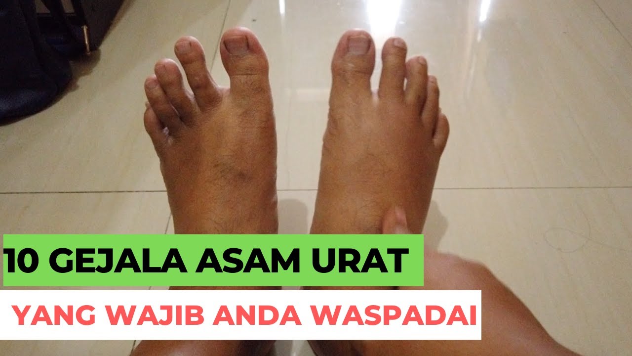 10 GEJALA ASAM URAT YANG WAJIB DIWASPADAI
