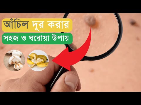 ভিডিও: কিভাবে সার্ফ ফুসকুড়ি এড়ানো যায়