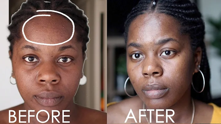 HOW TO GET RID OF FOLLICULITIS/THOSE TINY BUMPS |SKIN || TheAdeTomi