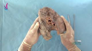 Famous Thotax Part-03 Right lung Profile