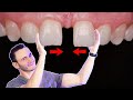 Espacio entre los dientes | Tratamientos para cerrar un "Diastema"