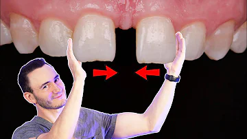 ¿Los espacios entre los dientes son antiestéticos?