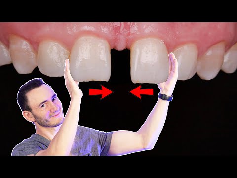 Vídeo: Diastema: Dientes, Tratamiento Y Hereditario