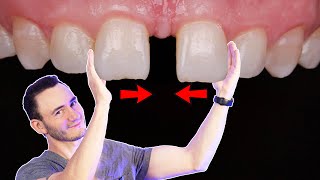 Espacio entre los dientes | Tratamientos para cerrar un \