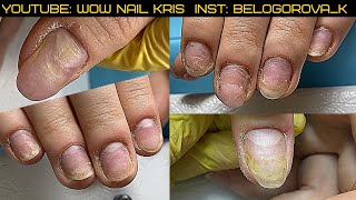 видео: Травма, ОНИХОЛИЗИС- доносить ВСЕМ с особой СТРОГОСТЬЮ!Неосведомлённость клиентов-какие Последствия картинка: Травма, ОНИХОЛИЗИС- доносить ВСЕМ с особой СТРОГОСТЬЮ!Неосведомлённость клиентов-какие Последствия