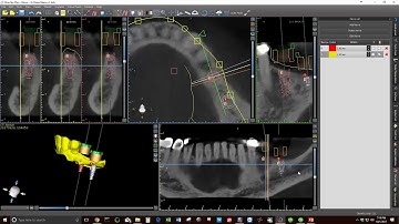 BSP Nerve Verify Mapping