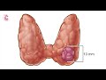 Work-Up of Thyroid Nodules