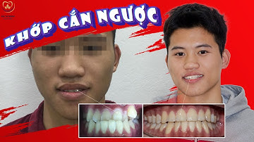 Khớp Cắn Ngược Và Sự Thay Đổi Sau Khi Niềng Răng Mắc Cài | Các Case Lâm Sàng #4