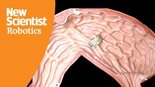 Tiny, shape-shifting robot can stop bleeding from inside the body using heat.