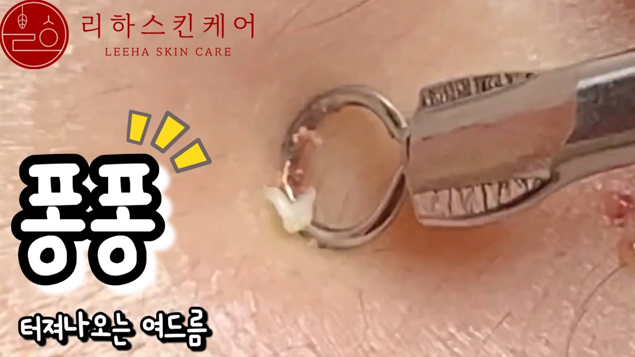 여드름성지| 퐁퐁 터져나오는 여드름 - YouTube