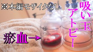 【閲覧注意　吸い玉】なにこれ血が止まらない…ドロドロ血液…赤ちゃんの頃からアトピーに悩む女子【グラン治療院　ブエノスカリン院】