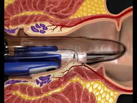 before and after stapled hemorrhoidectomy before and after stapled hemorrhoidectomy