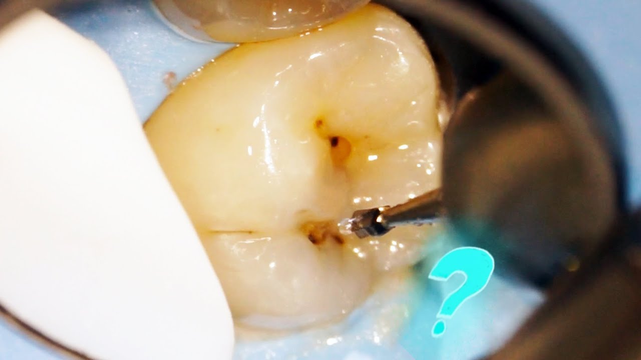 what-lies-beneath-that-dark-spot-on-your-tooth-youtube