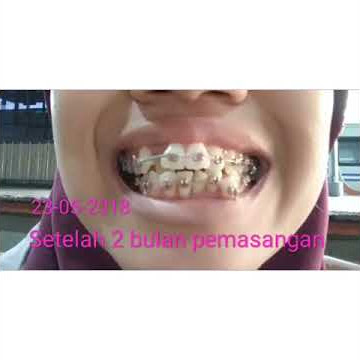 GIGI BEHEL PASANG GIGI KAWAT, JANGAN LUPA DI SUBSCRIBE