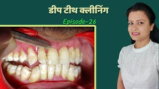 deep teeth cleaning | danto ki safai । Episode  26