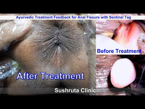 Birlashtirilgan qin va anus fotosurati