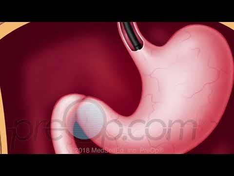 This video demonstrates an endoscopy procedure for a suspected bleeding ulcer.. 