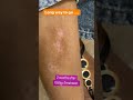 Vitiligo Treatment In Chandigarh Dermatologistinchandigarh Chandigarh Shorts